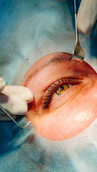 Vitreoliza laser