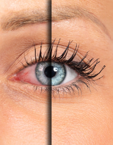 Tratamentele moderne ale Sindromului de ochi uscat